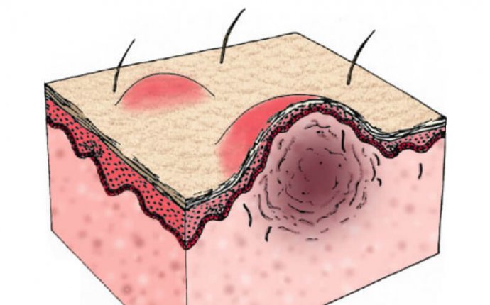 Keloid Disease