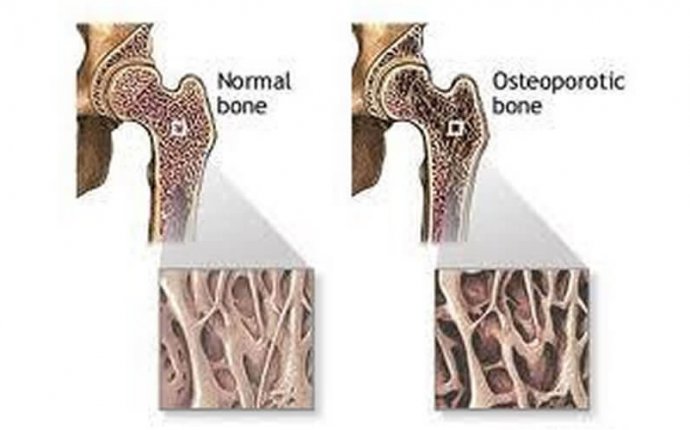 Osteoporosis | ayurvedic treatment for Osteoporosis