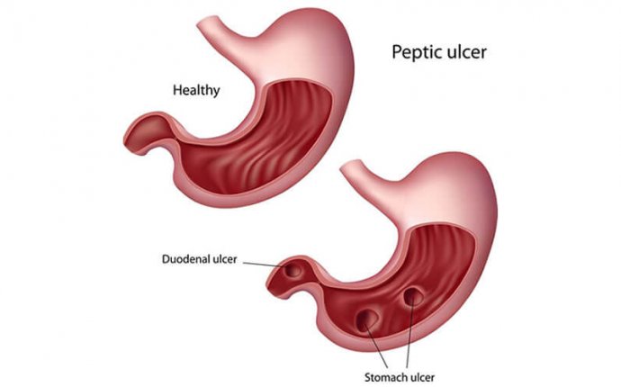 Peptic Ulcer | ayurvedic treatments for peptic ulcer