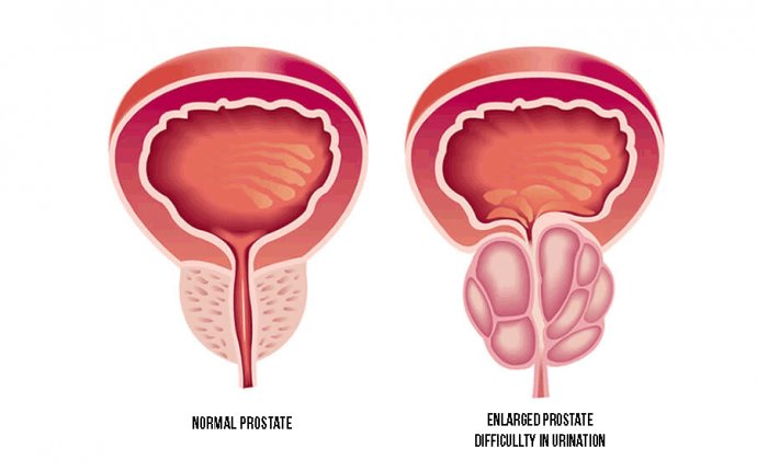 Prostate treatment in ayurveda | Grocare