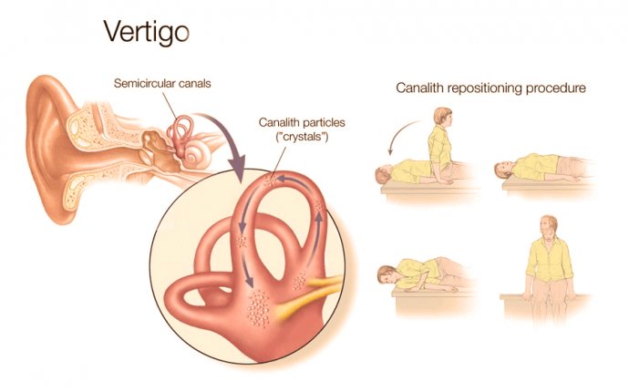 Vertigo Medication - Ayurvedic Treatment to Cure Vertigo | Grocare