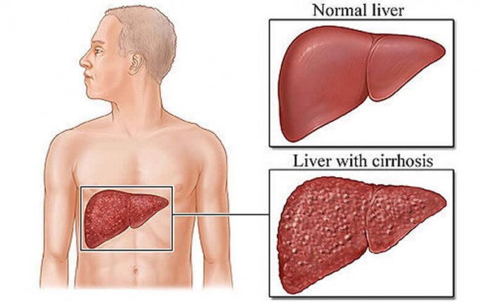 Liver and Ayurveda