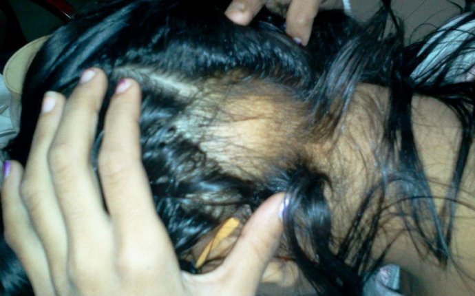Alopecia Ayurveda