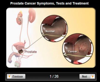 Prostate Cancer Pictures Slideshow: Visual Guidelines to Symptoms, Tests and Treatment