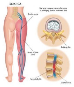 sciatica