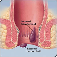 Shreyash Hospital - hemorrhoids, hemorrhoid, hemroids, hemorrhoids cure, treat hemorrhoids, hemorrhoids relief, hemorrhoid creams, hemorrhoid treatment, external hemorrhoids, piles, compost piles, sheet piles, Haemorrhoids, Piles Treatment, Bleeding Piles, Bleeding Hemorrhoids, Piles Hemorrhoids, Anal bleeding, Rectal Bleeding, rectal hemorrhage, Internal piles, Internal Hemorrhoids, Ayurvedic treatment, Ksharasutra, ksharsutra, ksharsootra, ksharsutra treatment in gujarat, india, asia.